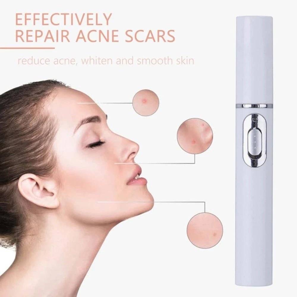 Blue Light Therapy Acne Laser - Urban Mart